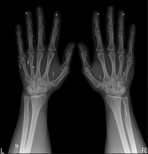 radiografia mani 